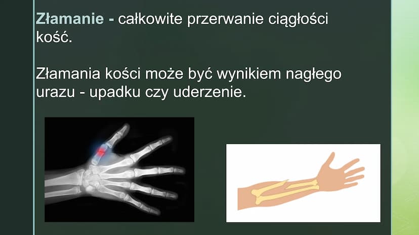 
<p>Urazy kończyn zdarzają się często. Czasami urazy, takie jak upadek na oblodzonym chodniku czy uderzenie się piłką w wyprostowany palec, 