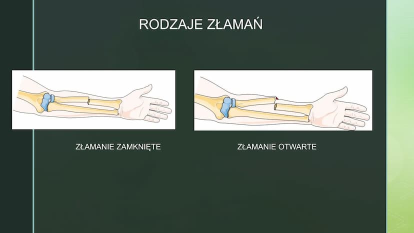 
<p>Urazy kończyn zdarzają się często. Czasami urazy, takie jak upadek na oblodzonym chodniku czy uderzenie się piłką w wyprostowany palec, 