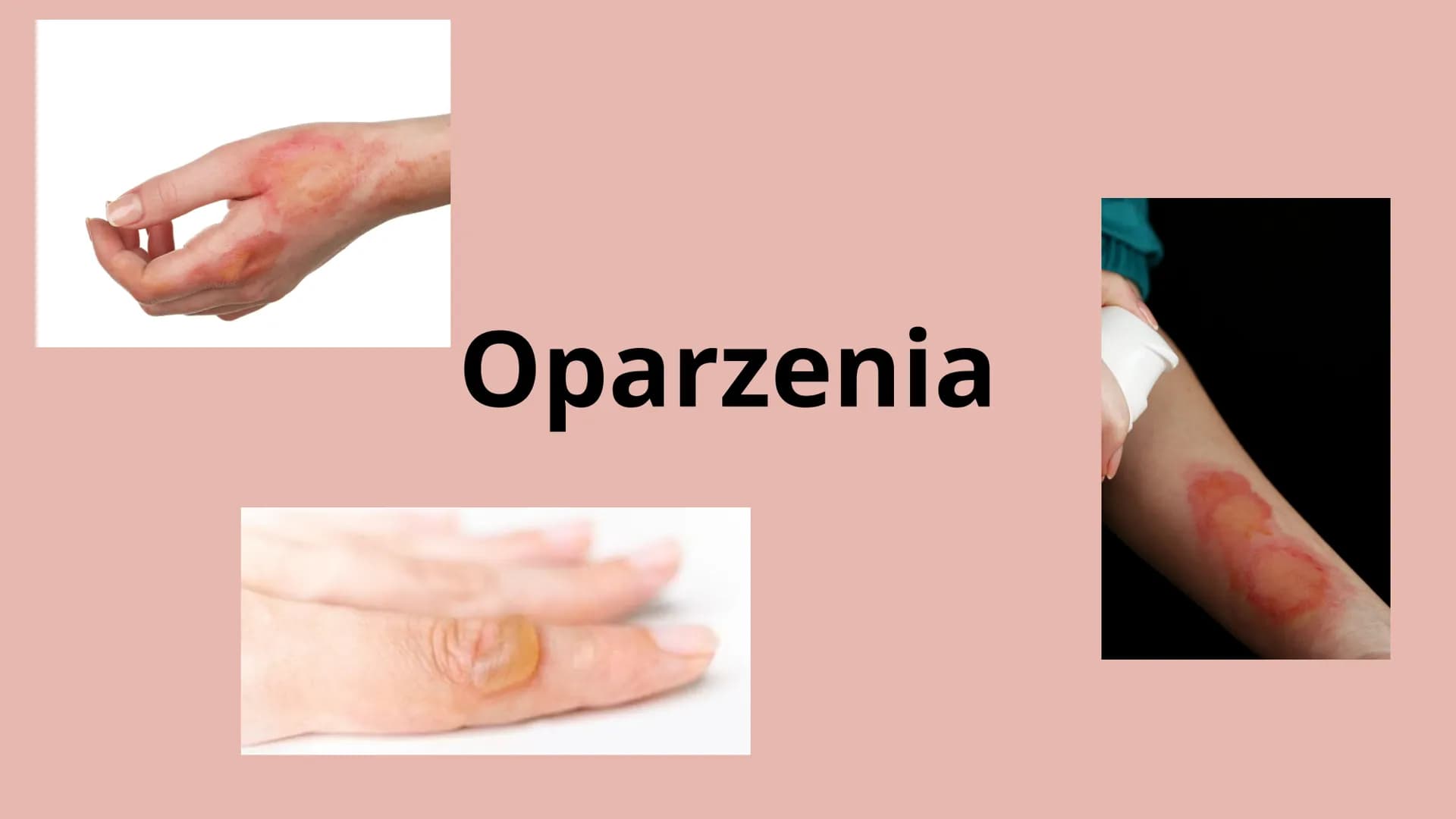 Oparzenia Co to oparzenie?
Oparzenie to - w zależności od głębokości - uszkodzenie skóry lub głębiej
położonych narządów na skutek działania