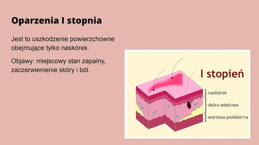 Oparzenia Co to oparzenie?
Oparzenie to - w zależności od głębokości - uszkodzenie skóry lub głębiej
położonych narządów na skutek działania