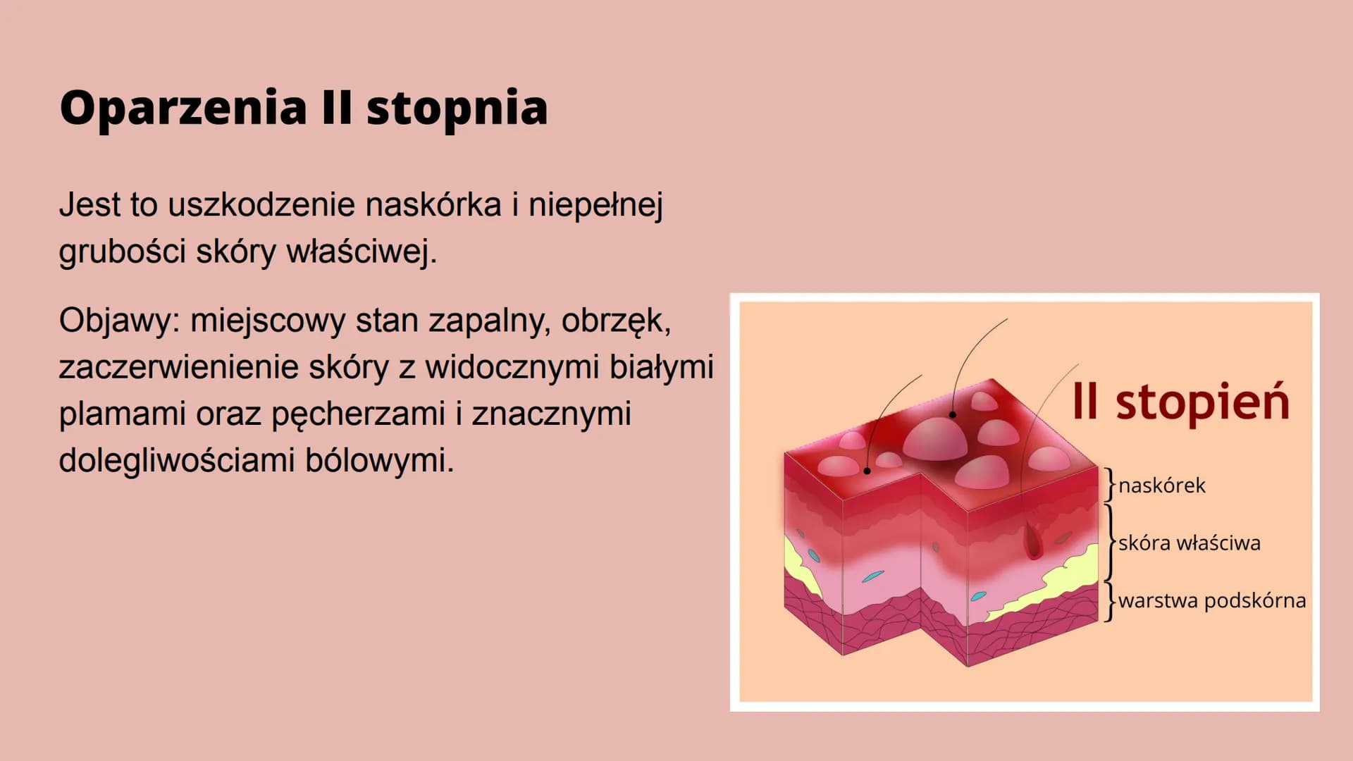 Oparzenia Co to oparzenie?
Oparzenie to - w zależności od głębokości - uszkodzenie skóry lub głębiej
położonych narządów na skutek działania