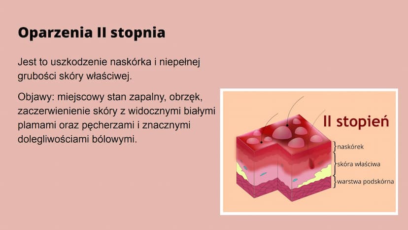Oparzenia Co to oparzenie?
Oparzenie to - w zależności od głębokości - uszkodzenie skóry lub głębiej
położonych narządów na skutek działania