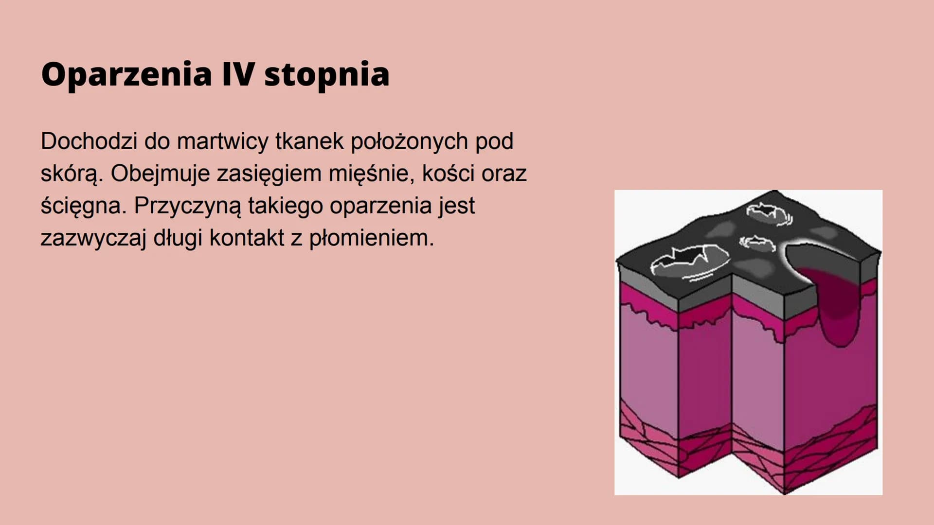Oparzenia Co to oparzenie?
Oparzenie to - w zależności od głębokości - uszkodzenie skóry lub głębiej
położonych narządów na skutek działania