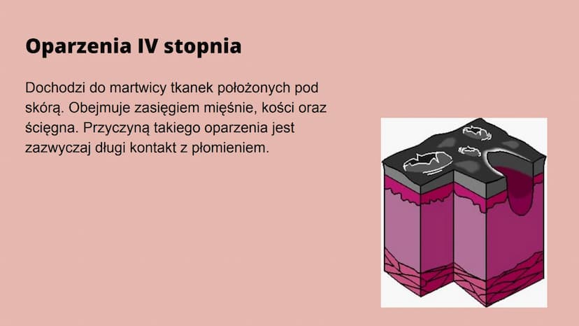 Oparzenia Co to oparzenie?
Oparzenie to - w zależności od głębokości - uszkodzenie skóry lub głębiej
położonych narządów na skutek działania