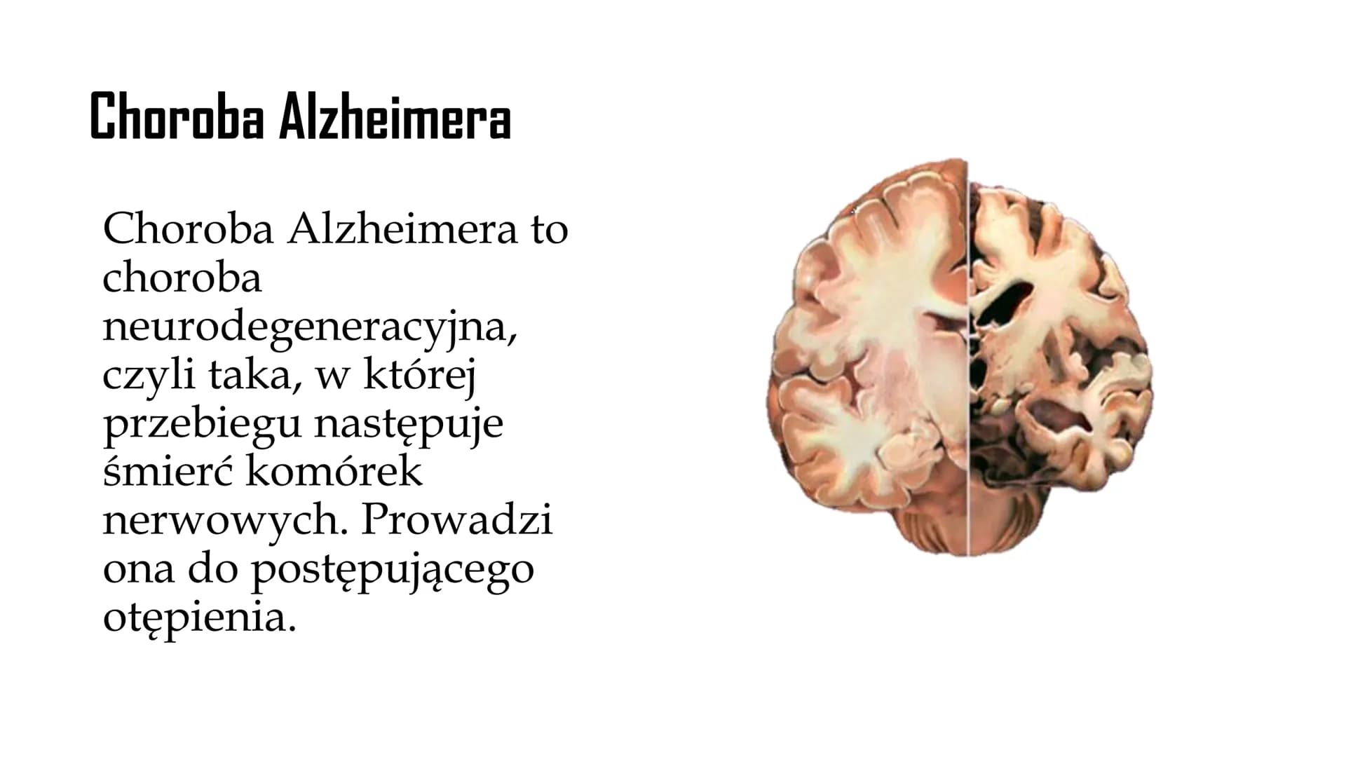 
<p>Choroba Alzheimera to neurodegeneracyjna choroba, która prowadzi do postępującego otępienia. W przebiegu tej choroby w mózgu powstają ni