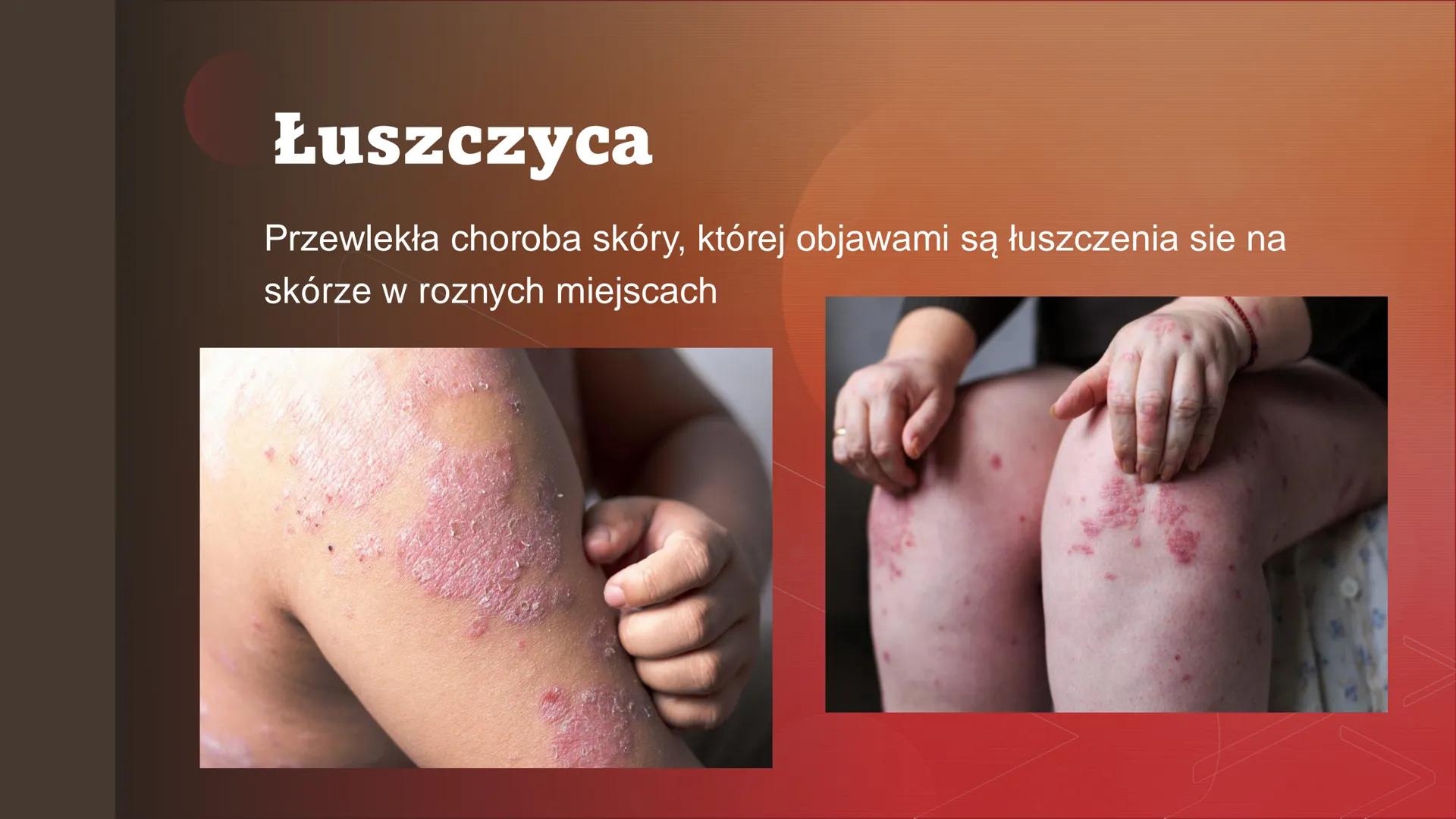 Zaburzenia
funkcjonowania
układu
odpornościowego Zaburzenia odpowiedzi
immunologicznej
Zaburzenia odpowiedzi immunologicznej moga
powodowac