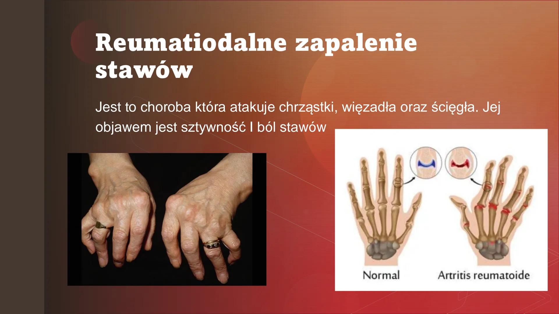 Zaburzenia
funkcjonowania
układu
odpornościowego Zaburzenia odpowiedzi
immunologicznej
Zaburzenia odpowiedzi immunologicznej moga
powodowac